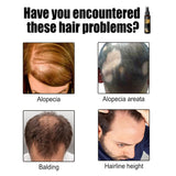 Geavanceerde haargroeibehandelingskit 30 ml 2 STUKS Haargroeispray Haargroeiroller en essentieset Haargroeiserum Anti-haaruitval Geavanceerd haargroeiserum Haarverzorging Naty Shop